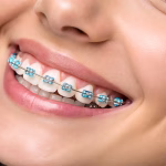 Braces 101: How They Work and Why You Might Need Them 4 understanding braces benefits explained